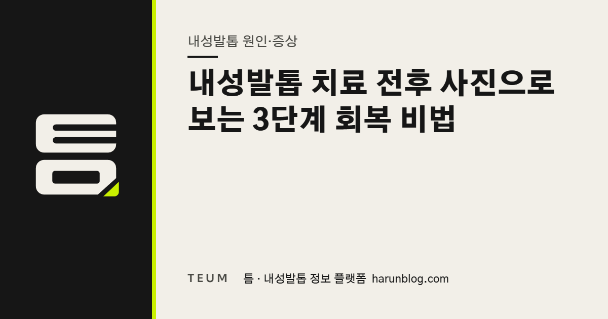 내성발톱 치료 전후 사진으로 보는 3단계 회복 비법 — 틈 내성발톱 정보 플랫폼